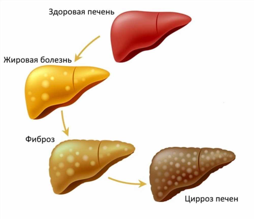 Цирроз печени: от чего начинается и как предотвратить