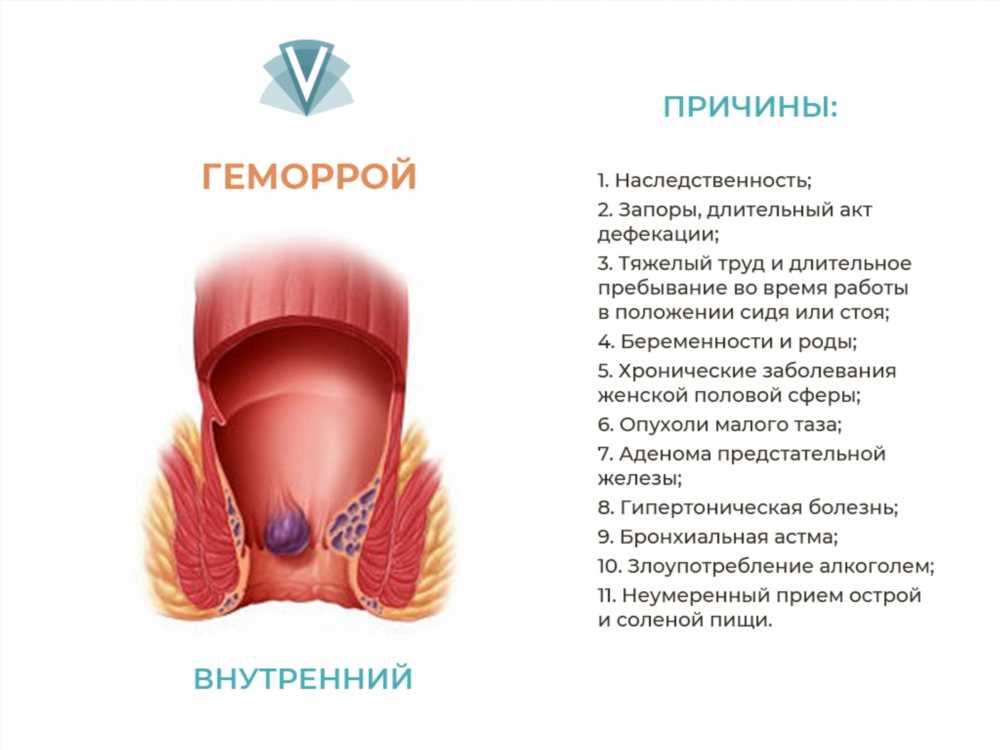 Эффективное лечение геморроя: секреты использования медикаментов