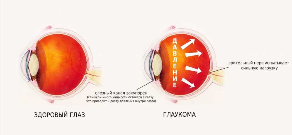 Глаукома: ключевые методы диагностики для сохранения зрения