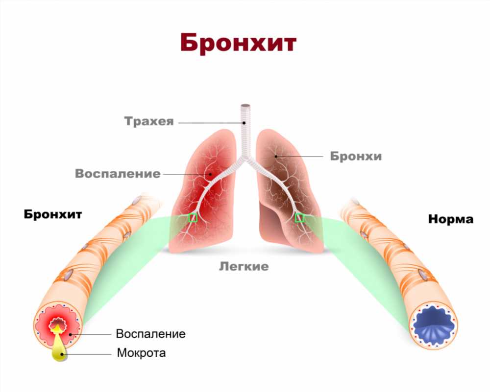 Инвитро исследование мокроты: ключевые аспекты, методы и значение