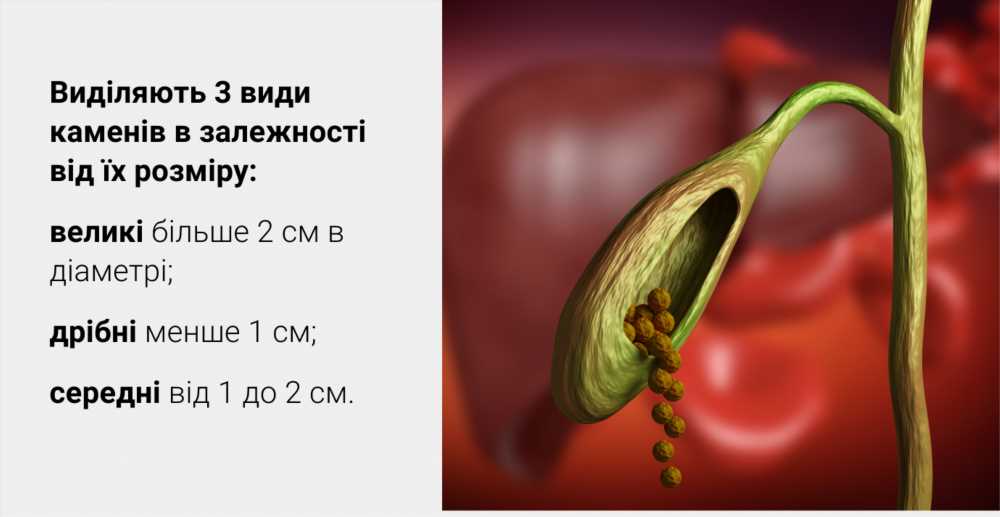 Желчные камни: причины, симптомы и профилактика