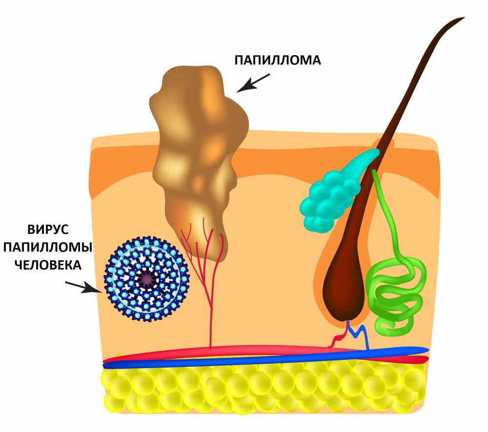 Как избавиться от папиллом народными средствами: эффективные методы без операции