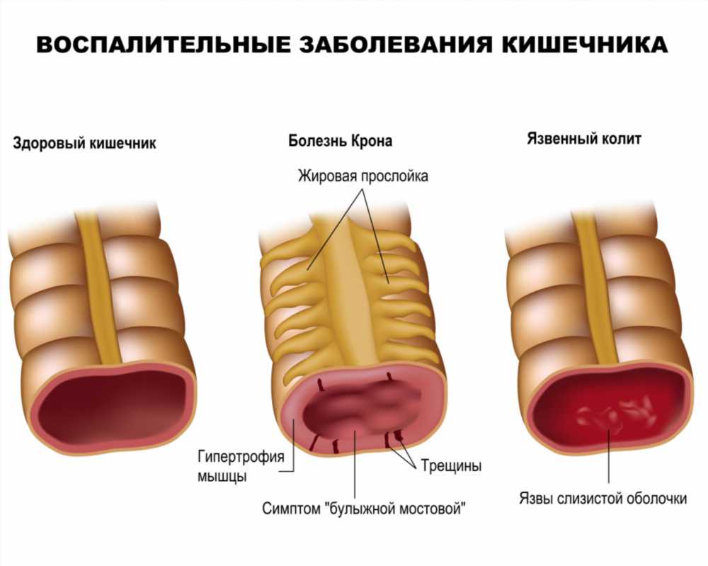 Кровь в кале после употребления алкоголя: причины и рекомендации