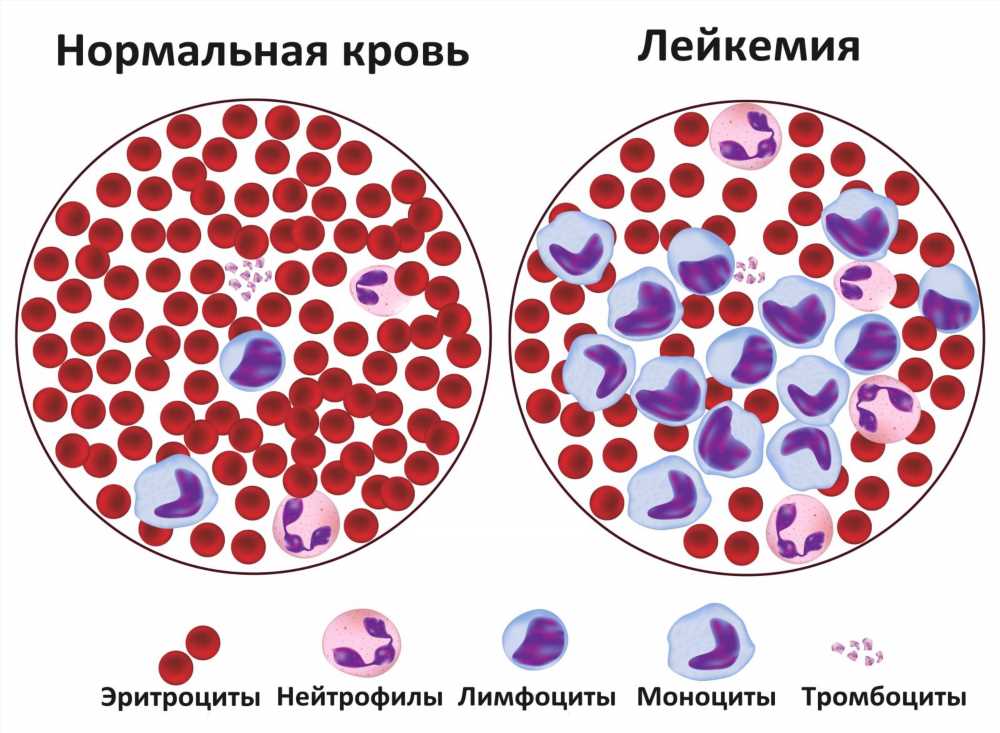 Лейкоз у детей: симптомы, формы и патология