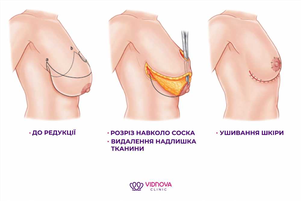 Маммопластика: Полное Руководство по Увеличению и Уменьшению Груди