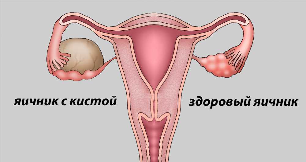 Опасности кисты яичника у женщин: причины, симптомы и последствия