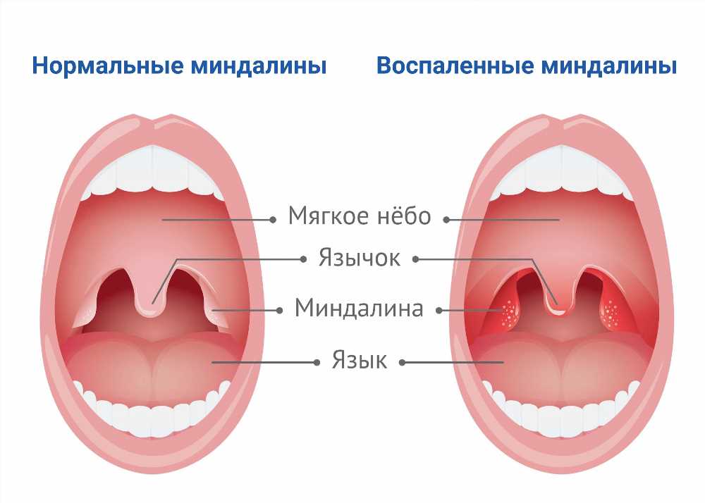 Осложнения от ангины местного характера: причины, симптомы и способы профилактики