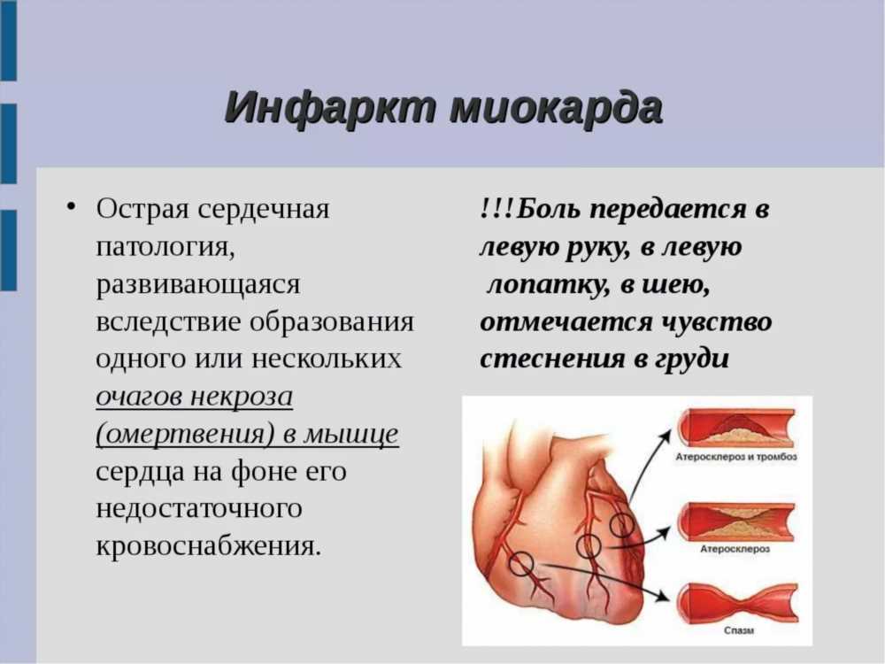 Острая стадия инфаркта миокарда: симптомы, диагностика и лечение