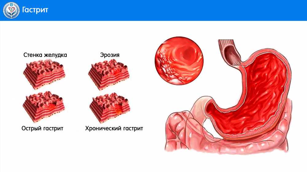 Отрыжка воздухом: причины и способы ее предотвращения