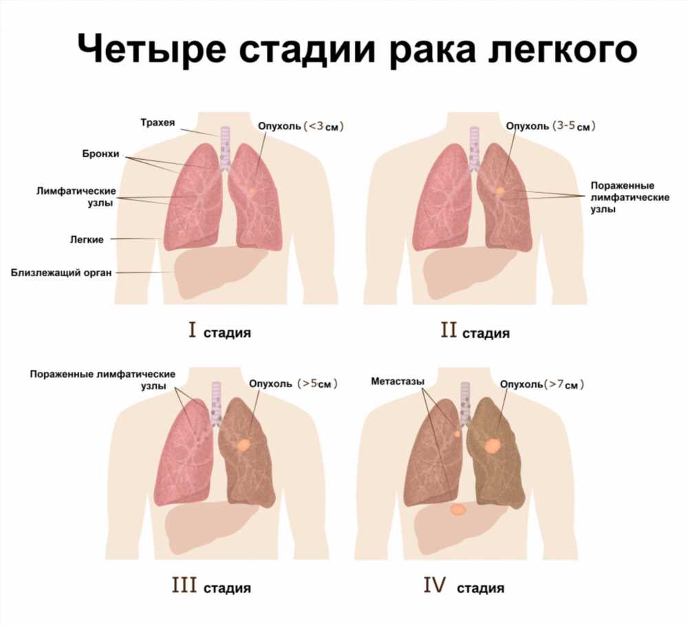 Симптомы невриномы на разных стадиях болезни: Понимание и Распознавание