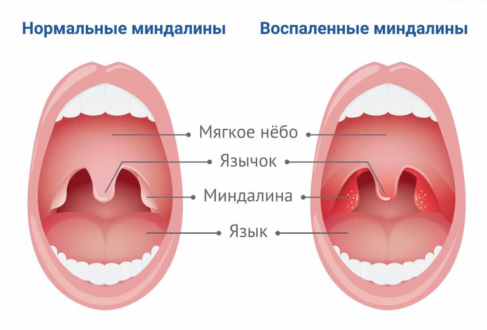 Удаление миндалин (гланд): когда такая процедура необходима?